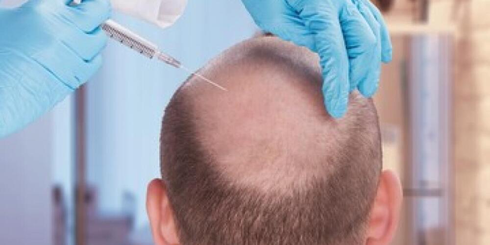 With Want Hair's FUE Hair Transplant Services, You Can Regain Your Confidence and Lost Hair