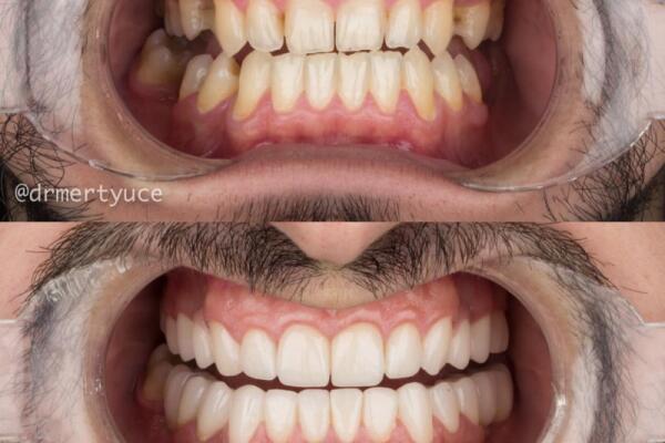 Smile Brighter with the Best Dental Care in Turkey, Istanbul: Want Smile