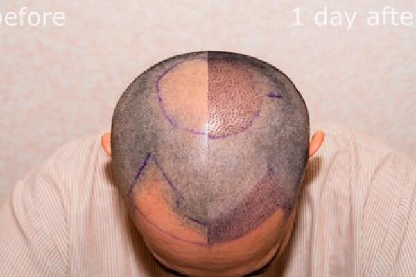 Boost Your Inner Confidence Through Hair Transplant Journey From Want Hair Ltd