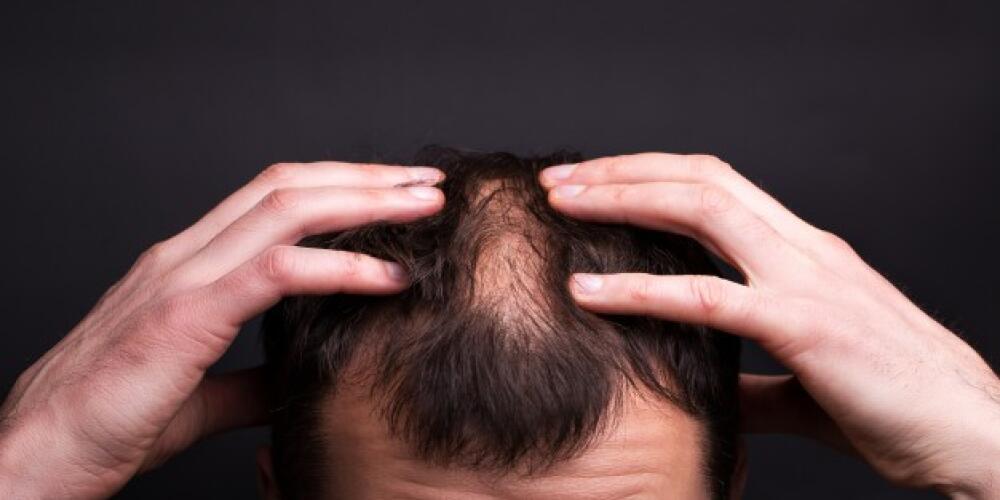 Want Hair Ltd: The Company That Provides Solutions for Male Hair Loss in the UK