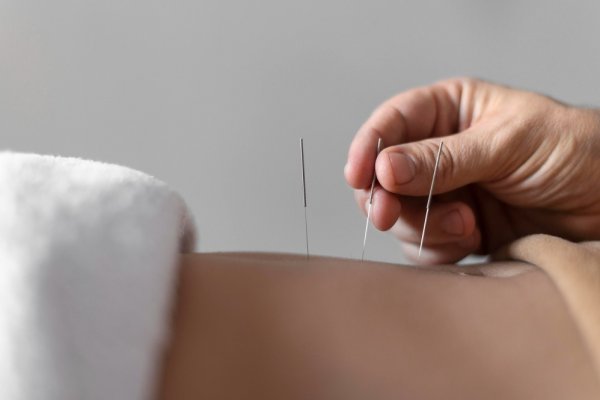 Dr. Acu Herbs Introduce Revolutionary Acupuncture Treatment in Dublin