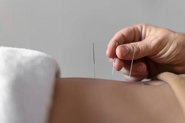 Acupuncture Promotes Natural Healing Solutions