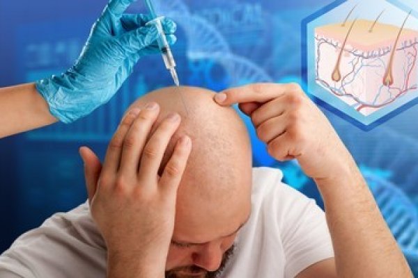 Want Hair Makes Hair Restoration Easy and Safe for You